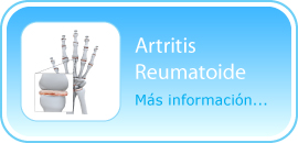 Descubra su ADN y conozca cómo prevenir y/o tratar la artritis reumatoide